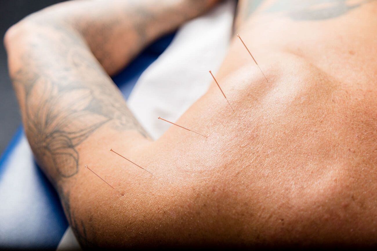 Sports injury acupuncture treatment