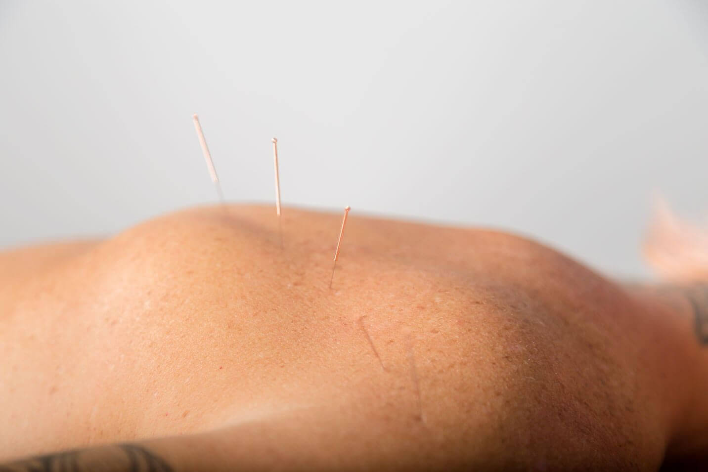 Acupuncture needles used in sports injury therapy