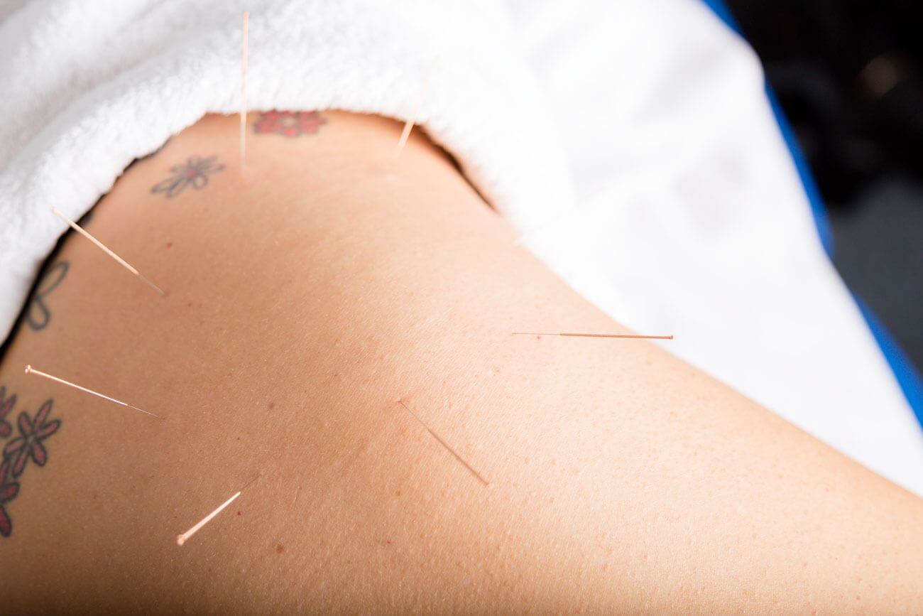 Sports injury acupuncture session at Euphoria Sports Therapy